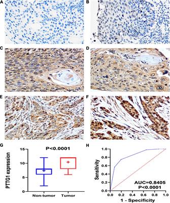 The Clinical Significance and Potential Molecular Mechanism of PTTG1 in Esophageal Squamous Cell Carcinoma